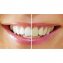 Kit dents blanches, 7 elements - 1