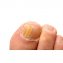 Crème antifongique pour les (ongles des) pieds - 2