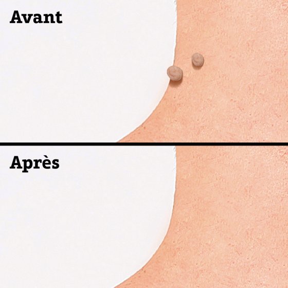 Patchs pour verrues pédiculées 