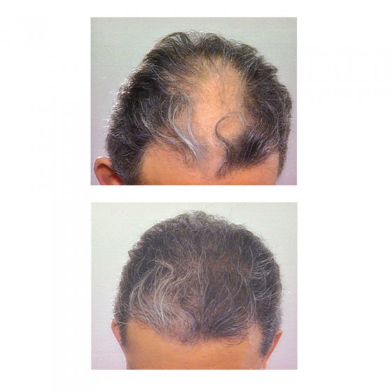 Système laser pour tonifier les cheveux
