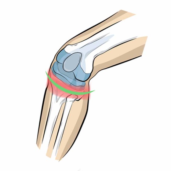 Genouillère pour le tendon rotulien 