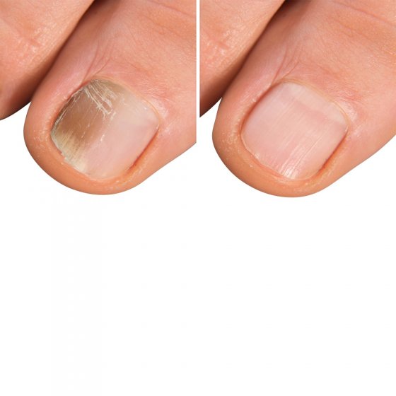 Spray contre les mycoses des pieds et des ongles 