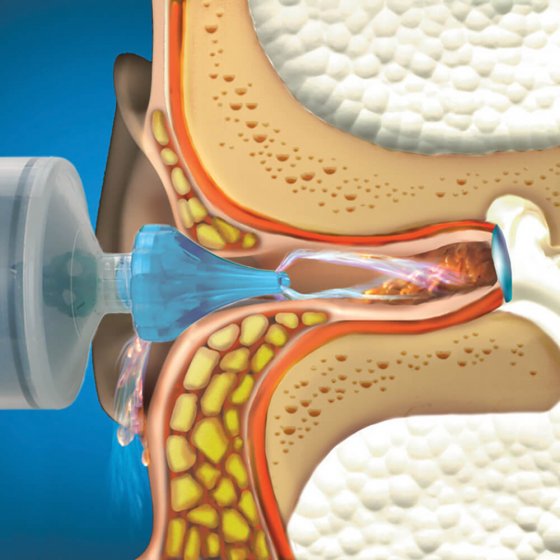 Nettoyer ses oreilles : nos conseils - Conseils santé